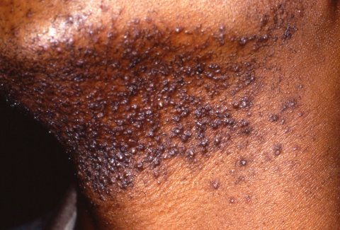 [Image: Pseudofolliculitis_Barbae.jpg]